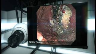 preview picture of video 'Gastric Cancer'