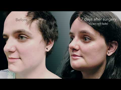 Facial Feminization Surgery with Dr. Seattle