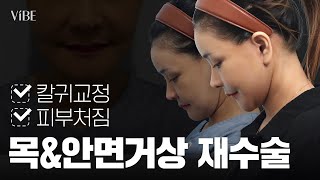 [성형 Vlog] 칼귀만 남긴 첫 안면거상... 재수술 전 과정 공개!｜안면거상 & 목거상 1개월 전후 변화