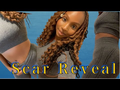 Tummy Tuck Journey: Post Op Week 8: Scar Reveal, Q&A, & Chit Chat