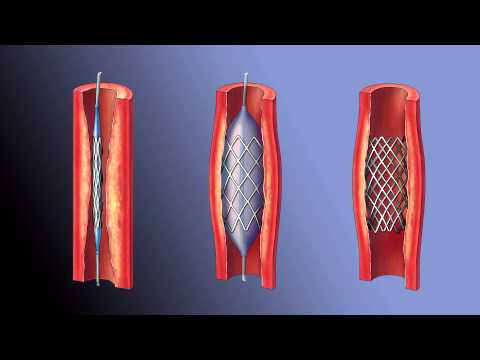 Аортокаронарное шунтирование Аортокаронарное шунтирование