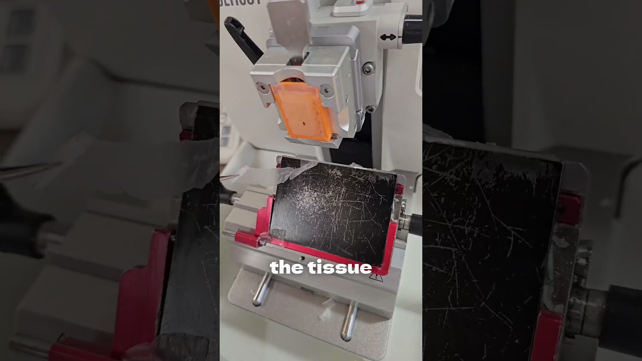 Understanding Breast Biopsies
