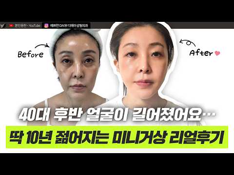 미니거상 상담 갔다가 눈 지방이식까지! 40대 여성 콤플렉스 한 번에 지우기ㅣ디에이성형외과 ㅣ40대 미니거상