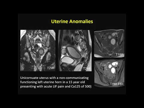 endometrium rák mri