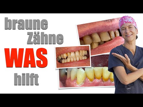 BRAUNE Zähne, VERFÄRBUNGEN, und jetzt? URSACHEN