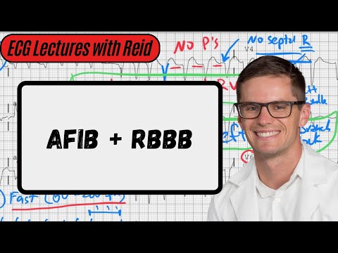 Atrial Fibrillation w/ Right Bundle Branch Block | Day 15 ECG Challenge