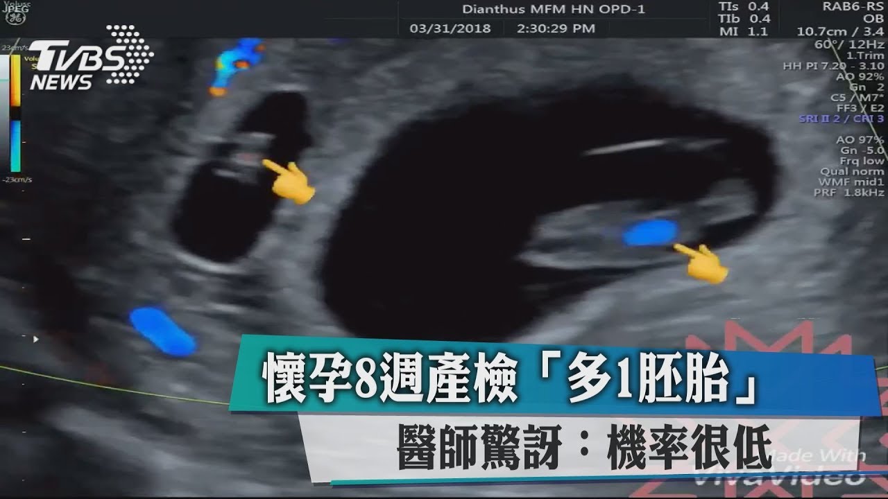 懷孕8週產檢「多1胚胎」 醫師驚訝:機率很低