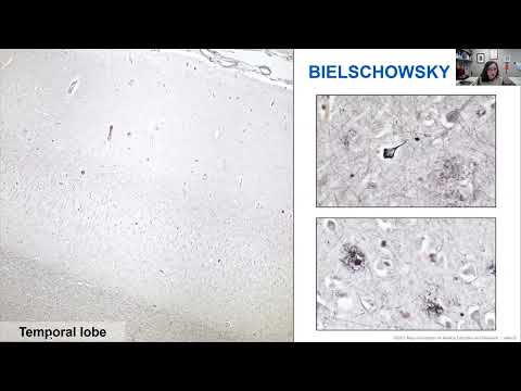 AANP Teaching Rounds - August 28, 2024 - Practical Approach & Evaluation Neurodegenerative Diseases