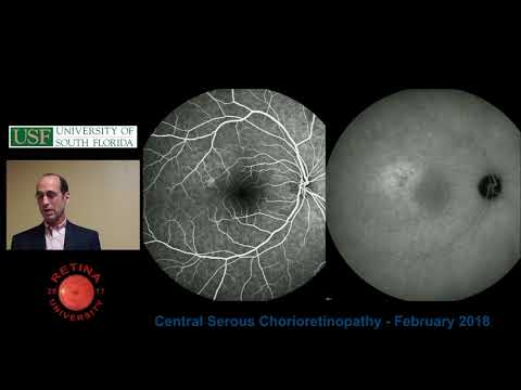 Central Serous Chorioretinopathy