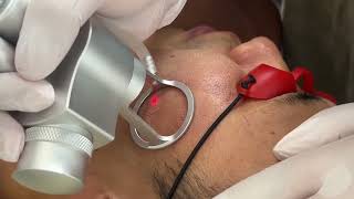 Fractional Co2 laser skin rejuvenation
