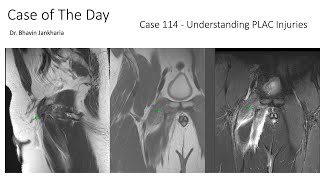 Case of the Day - 114 - 2025 10 07 - Understanding PLAC Injuries