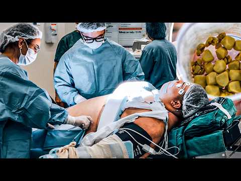 "Gordão da XJ had 24 gallstones removed (look how it turned out) 😱"