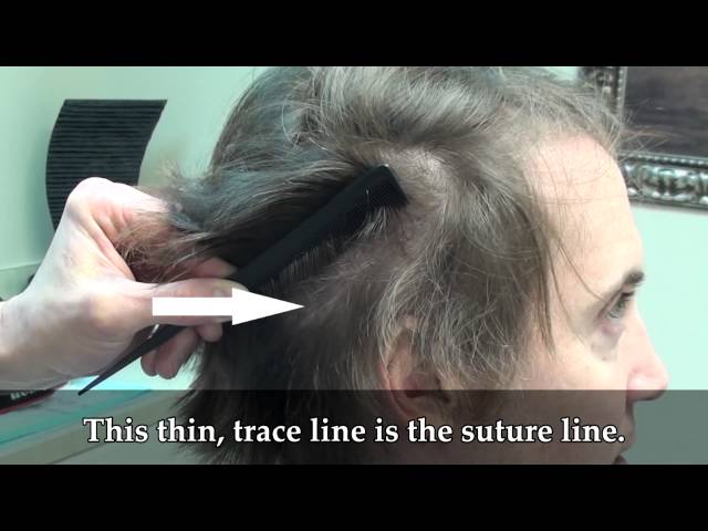 Jeff's Undetectable Scar: 4mo