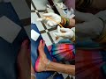 Female Foley Catheter Demo