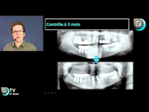comment traiter une sinusite maxillaire