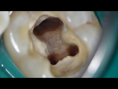Meniscus Gelenk- und Betrieb Rückenschmerzen Aufstoßen
