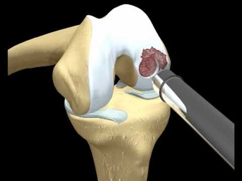 Funzionamento artroscopia spalla costo Dolori alle articolazioni del pollice che medico