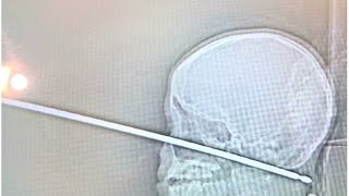 Boy survives falling from tree house, face first on meat skewer