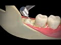 Wisdom Teeth Extraction - Step by step