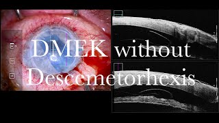 DMEK without Descemet Stripping after 3 failed penetrating Keratoplasties