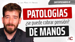 Patologías de manos y muñecas: Criterios para Incapacidad Permanente