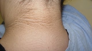 Acanthosis Nigricans [DermTV.com Epi #452]