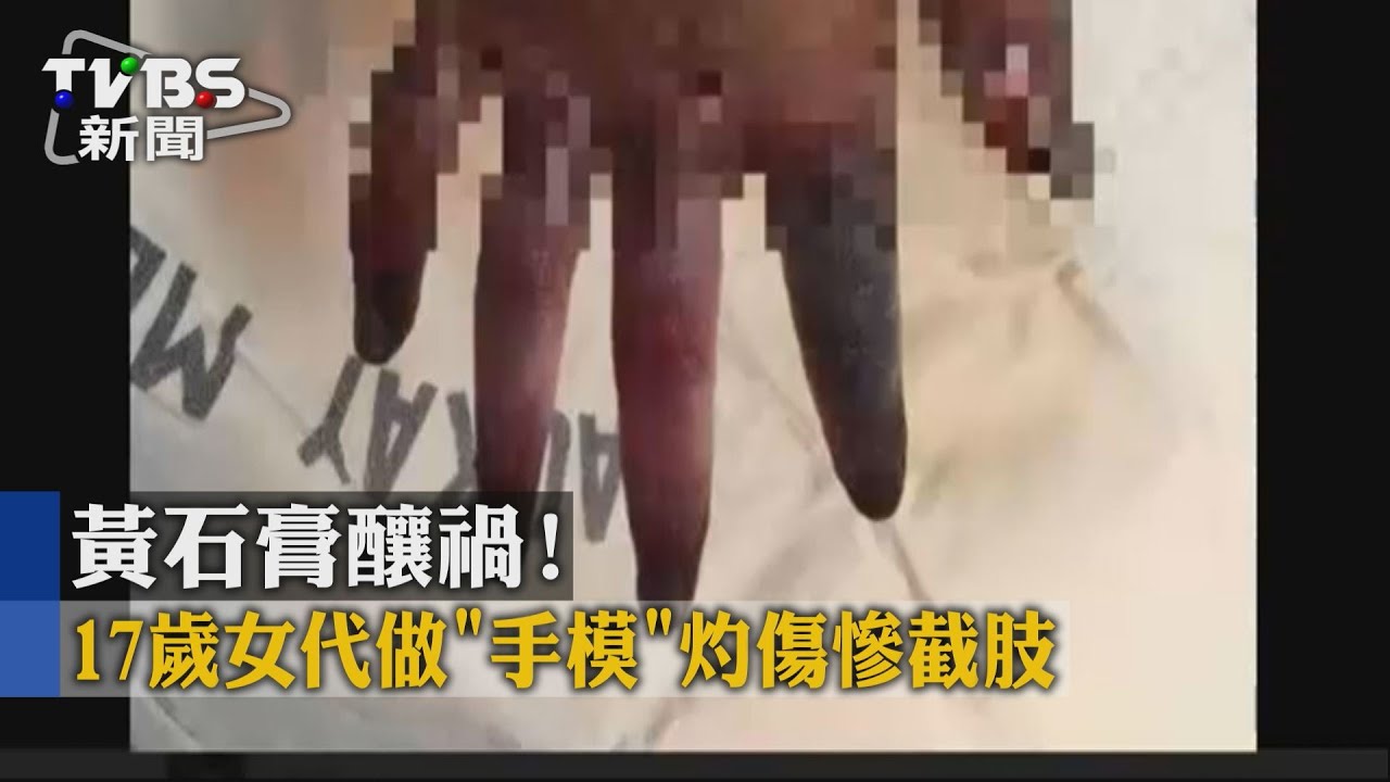 黃石膏釀禍！　17歲女代做「手模」灼傷慘截肢