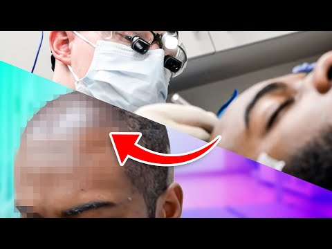 I Performed an FUE Hair Transplant (2,000 Grafts;...