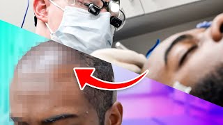 I Performed an FUE Hair Transplant (2,000 Grafts; African American Man)
