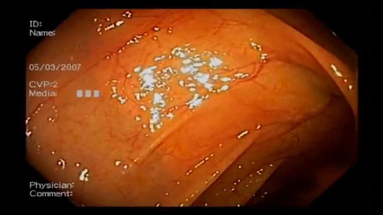 Colonoscopy