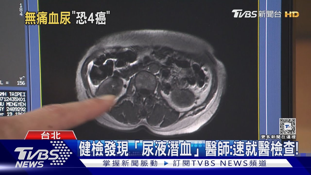 無痛無症狀 尿液變成「這顏色」 醫師:發現恐晚期