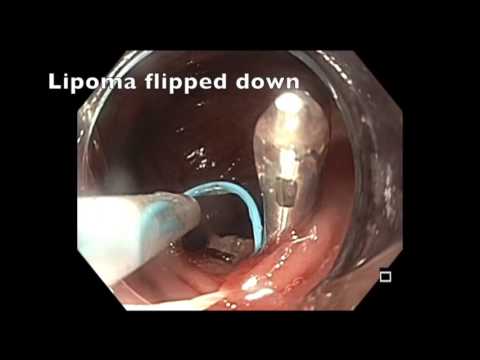 Colonoscopy: Sigmoid lipoma loop ligation