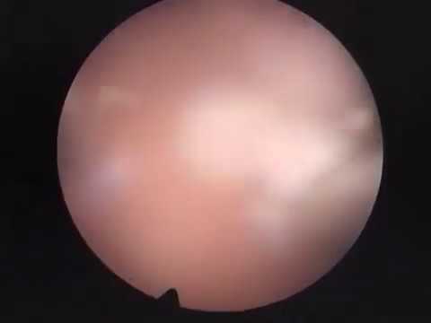 comment traiter un fibrome de 5 cm