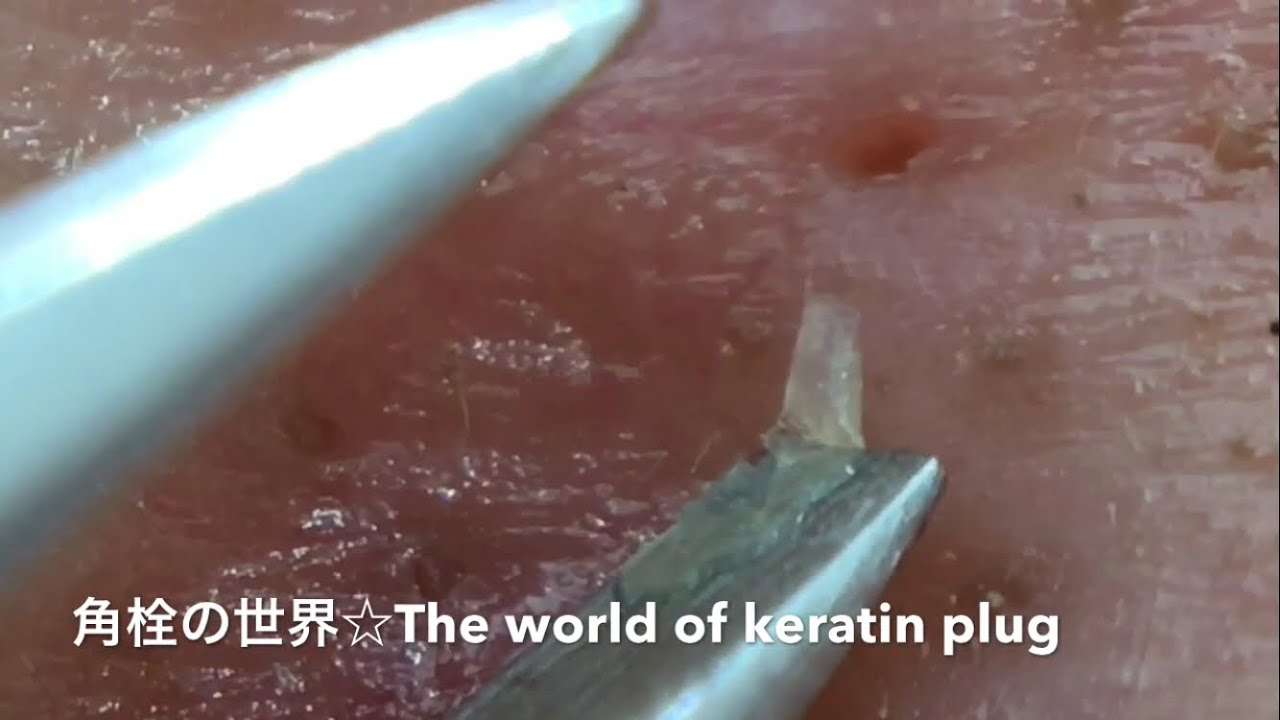 【No.18】角栓連続抜き！I try to take the keratin plug.