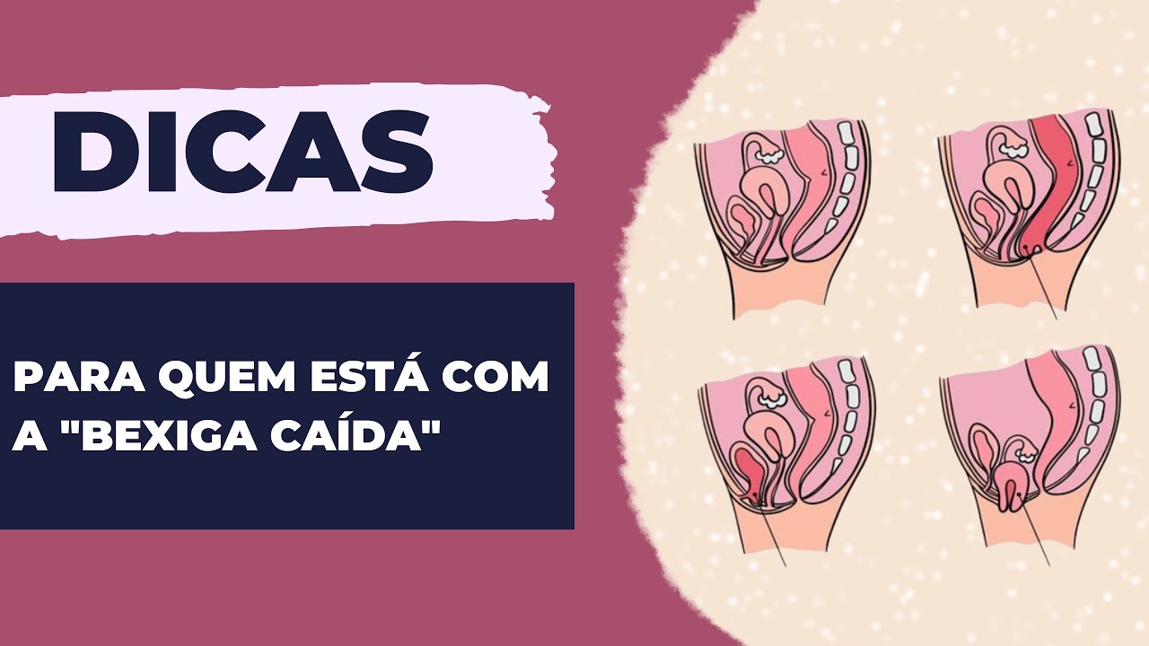 DICAS PRA QUEM ESTÁ COM A "BEXIGA CAÍDA" E VAI FAZER ACADEMIA