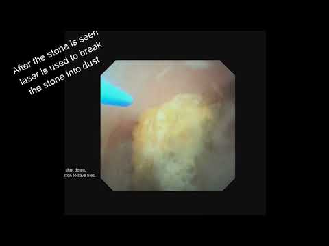  How is RIRS done for kidney stone removal with laser? | Dr. S K Palash