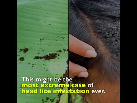 The Worst Case of Head Lice Infestation?! Kapuso Mo, Jessica Soho