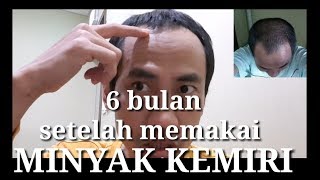 Download lagu Pemakaian minyak kemiri setelah 6bulan hasilnya sangat..... mp3 Download lagu Pemakaian minyak kemiri setelah 6bulan hasilnya sangat..... mp3