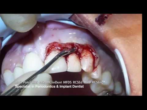 Image for Video Crown Lengthening - clinical case