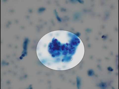 Cervical smear cytology  - AGC (Endometrial cells)