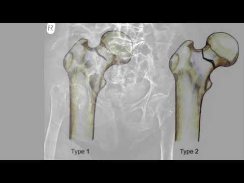 Femoral neck insufficiency fracture