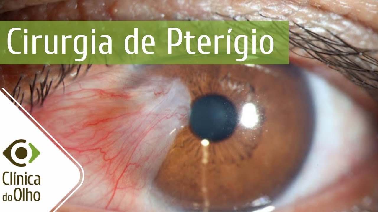 Cirurgia de Pterigio VT - Clínica do Olho