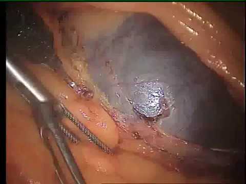 comment soigner kyste rein