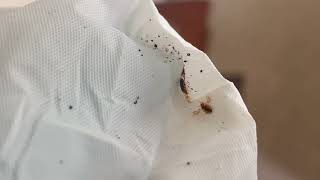 Watch video: Corners of Bed Sheets Full of Bed Bugs in Aberdeen, NJ