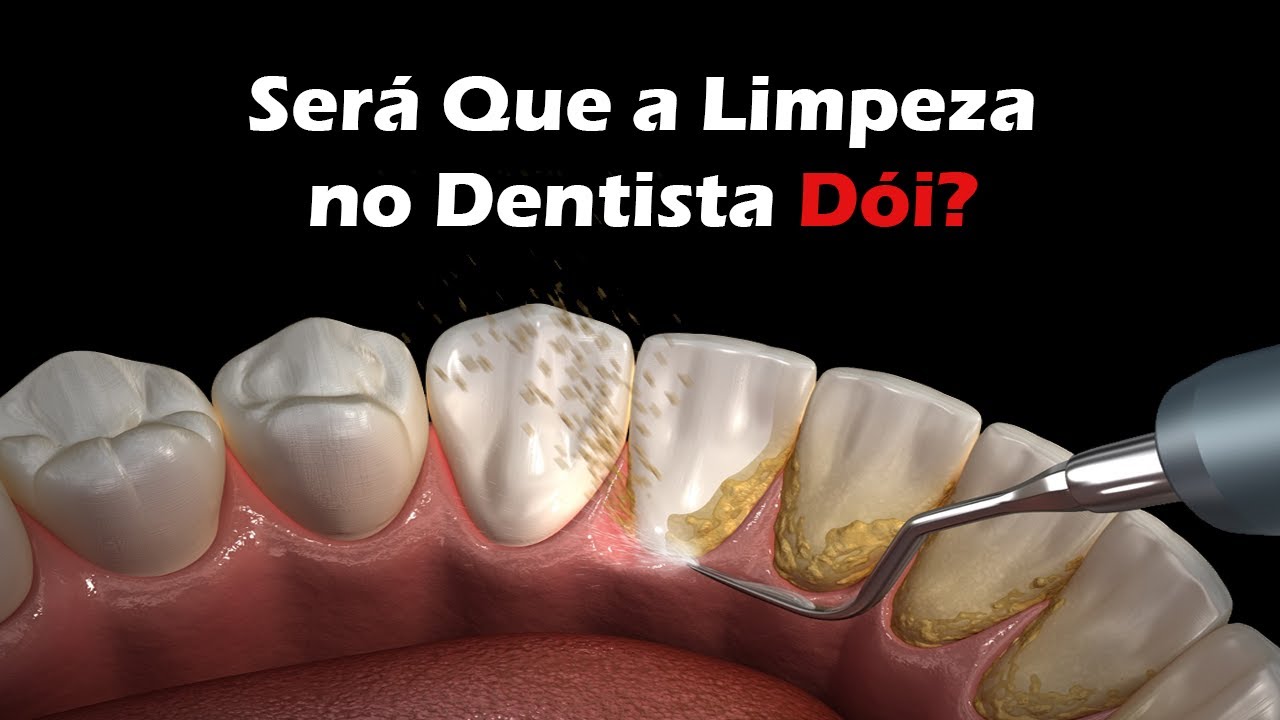 Watch Now Como é Feita a Limpeza no Dentista - Remoção De Tártaro Como é Feita a Limpeza no Dentista - Remoção De Tártaro