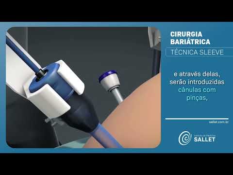 Técnica Sleeve | Cirurgia Bariátrica 3D