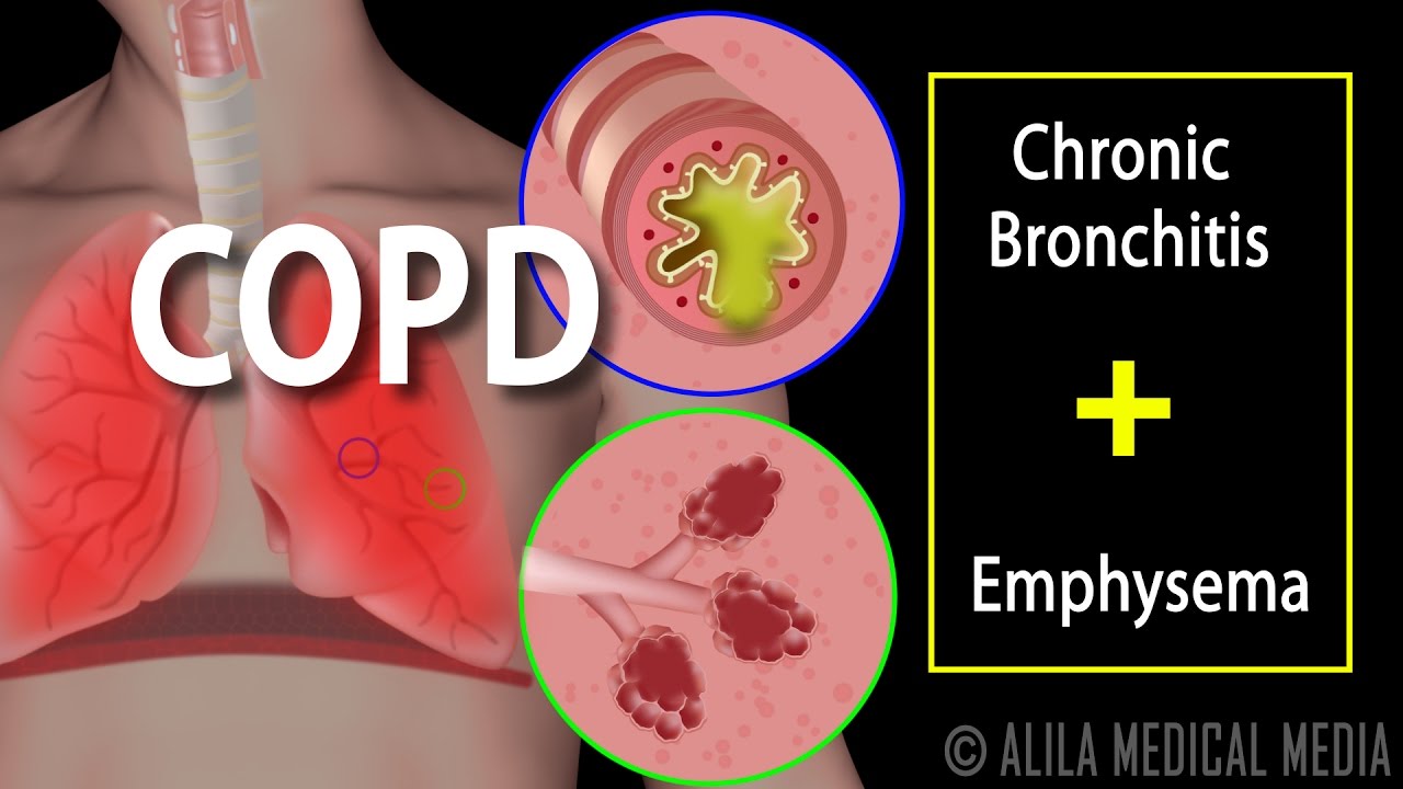 COPD - Chronic Obstructive Pulmonary Disease, Animation.