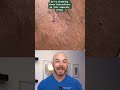 Derm Reacts To Armpit Cyst Removal Dermreacts Doctorreacts HS Cyst