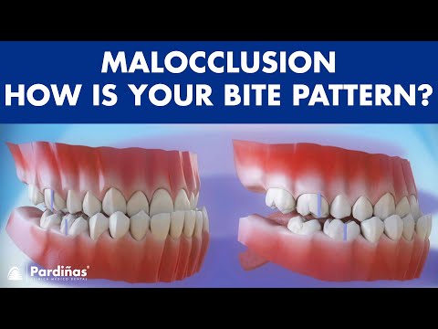 Malocclusion – Bite patterns ©