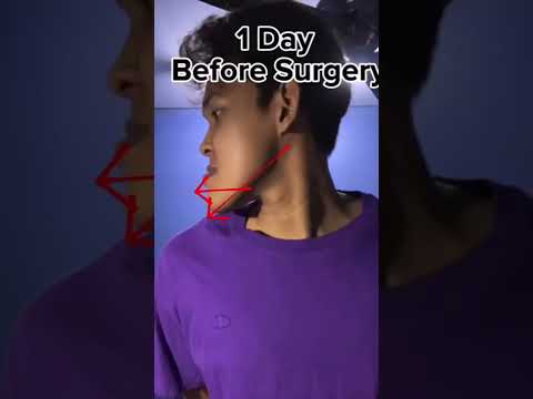 Jaw Surgery + Braces Explained 😬 Underbite With Anterior Open Bite